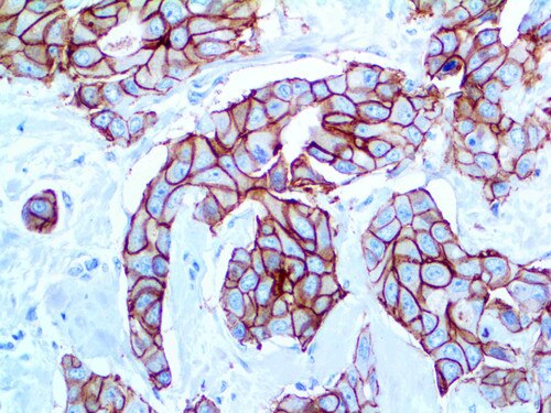 HER-2 Rmab neu Antibody Immunohistochemistry on a FFPE Breast Carcinoma Tissue